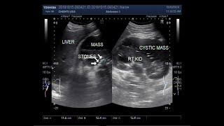 Ultrasound Video showing Cystic lesions in perinephric space known as lymphangiectasia [upl. by Nylessej687]