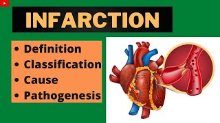 Infarction  Infarction In Hindi  Infarction  Easy Tricks  Pathology  Physiology [upl. by Ellened]