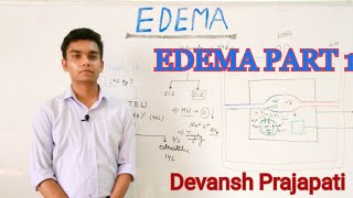 EDEMA PART 1 Pathophysiology intracellular edema [upl. by Marguerite]