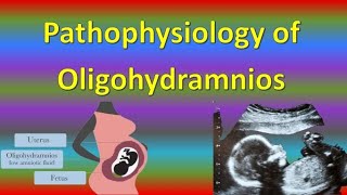 Pathophysiology of Oligohydramnios in Pregnancy [upl. by Ajani]