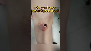 Do you have severe psoriasis psoriasis [upl. by Neona5]