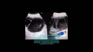 Retroperitoneal complex cystic lesion  hydatid disease  abscess [upl. by Airamesor]