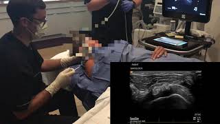 Ultrasound guided aspiration and lavage of calcific tendinitis [upl. by Alenas]