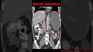 Splenic infarction  Cect Abdomen  Abdomen CT shorts radiology splenicinfrection [upl. by Auoh]