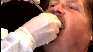 Complete Denture Procedure  01 Maxillary Preliminary Impression [upl. by Waldo]