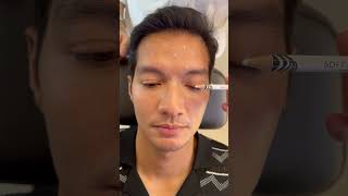 Botox for Men Brotox botox botoxinjections botoxfillers [upl. by Kalbli672]