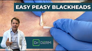 Easy Peasy Blackheads  Dr Derm [upl. by Kassity]