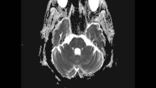 Persistent Trigeminal Artery [upl. by Annawot]