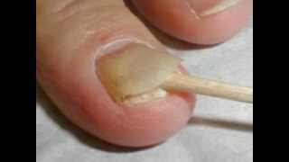 Nail psoriasis symptoms [upl. by Dirfliw467]