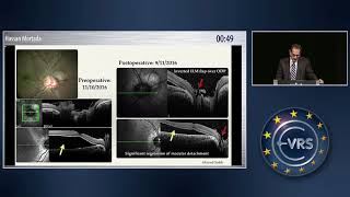 Inverted ILM Flap in Congenital Optic Pit Maculopathy Technique amp Results [upl. by Wenda]