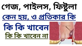 গ্যাজ রোগের চিকিৎসা । piles treatmenthemorrhoids treatmentpiles treatment at homepiles problem [upl. by Nednarb]