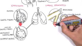 Chronic Obstructive Pulmonary Disease Overview types pathology treatment [upl. by Capello]