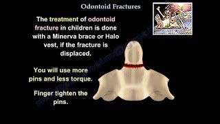 Odontoid Fractures  Everything You Need To Know  Dr Nabil Ebraheim [upl. by Symons]