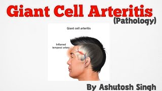 Giant Cell Arteritis Temporal Arteritis Pathology [upl. by Itnavart]