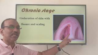 Nasal vestibulitis Urdu Patient teaching programme [upl. by Adine681]