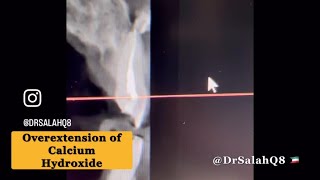 Overextension of Calcium Hydroxide and removal by Waterlase [upl. by Nahum]