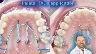 Wide range of palatal TADs applications mini screws palatelly benefits of mini implants in palate [upl. by Guibert]