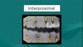 Bitewing Xray [upl. by Nosdrahcir]