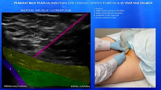 Ultrasound of Platelet Rich Plasma Injection for Osteitis Pubis in a 35 Year Old Female [upl. by Una]