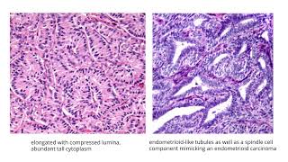 Sertoli cell tumorGYNpath [upl. by Odnalref33]