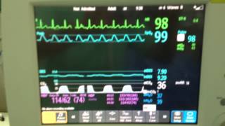 Desflurane in Morbid Obesity Washin Phase quot1112quot [upl. by Dnalwor]