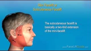 Steps of a Facelift Surgery [upl. by Armahs178]