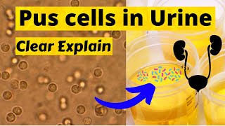 Pus Cells in Urine  What Is Pus Cell amp Pyuria  Causes Symptoms Normal Range Pus Cells In Urine [upl. by Etnovert481]