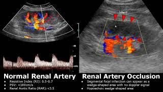 Renal Artery Doppler Ultrasound Normal Vs Abnormal Images  StenosisOcclusionAVM  Kidney USG [upl. by Haorbed674]