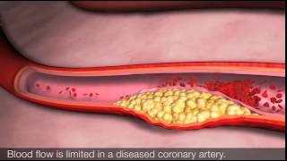 Angina and coronary heart disease [upl. by Harim]