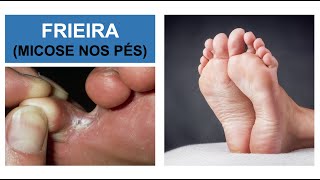 MICOSE NOS PÉS Frieira  Como combater Por Luiz Gameiro dermatologista [upl. by Tterraj]