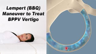 Lempert BBQ Maneuver to Treat BPPV Vertigo [upl. by Noonan]