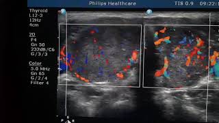 Thyrotoxicosis Sonography [upl. by Kannav]