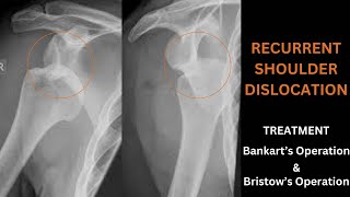 RECURRENT DISLOCATION OF SHOULDER JOINT  Puttiplatt operation  Bankart’s amp Bristow’s operation [upl. by Onitnas744]