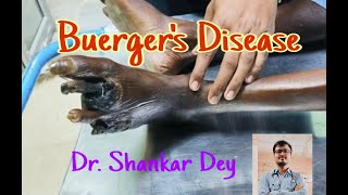 Buergers Disease  Case Demonstration  Dr Shankar Dey [upl. by Nahtaoj749]