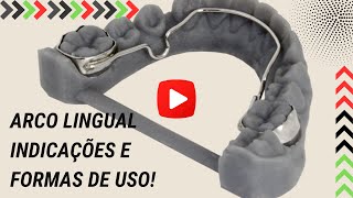 O arco Lingual Quais as suas indicações e formas de uso  Aula 152 [upl. by Hoon]