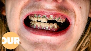 Can My Rotten Teeth Be Saved  Our Life [upl. by Ikaz]