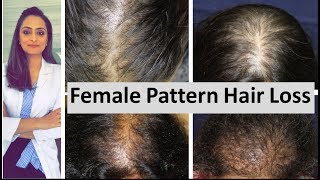 Hair loss in women  Female Pattern Hair Loss  causes amp treatment  Dermatologist [upl. by Ahsiekyt323]