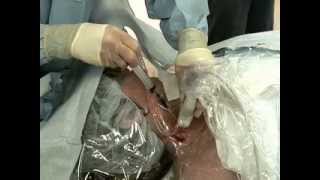 Placement of Central Venous Catheter  NEJM [upl. by Pauwles]