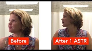 Chronic Neck amp Face Pain Was Relieved in Minutes REAL RESULTS [upl. by Ynhoj]