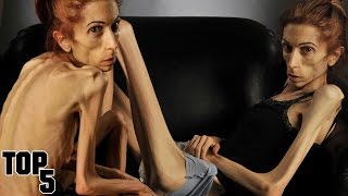 Top 5 Skinniest People In The World [upl. by Nilcaj]