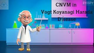 CNVM in Vogt Koyanagi Harada VKH Syndrome [upl. by Dorella]