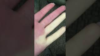 Raynauds disease overview [upl. by Kinson548]