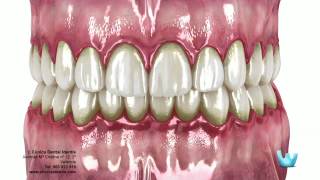 La enfermedad periodontal Gingivitis y Periodontitis [upl. by Rothberg451]