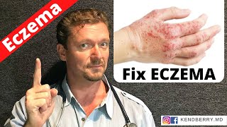 Is this Causing Your ECZEMA Easy Way to Tell 2024 [upl. by Hsakaa]