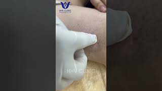 ĐIỀU TRỊ MỤN ÁP XE VÙNG NÁCH CAM KẾT HIỆU QUẢ SAU 1 BUỔI  TẠI PHÒNG KHÁM DA LIỄU HHV CLINIC [upl. by Anahoj]