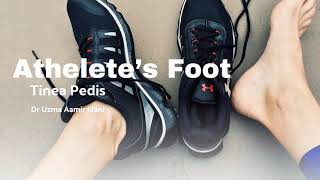 Learn about athletes foot a common fungal infection affecting athletes and nonathletes alike [upl. by Neelrihs]