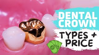 Dental Crowns Explained  WATCH BEFORE YOUR CROWN PROCEDURE [upl. by Aeet525]