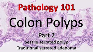 Colon Polyps  Part 2  Pathology 101 [upl. by Yessak]