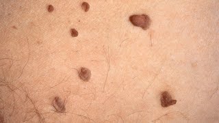 What is Skin Tags Acrochordon Causes Treatment [upl. by Lezned13]