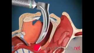 Endotracheal Intubation Animation [upl. by Aryahay]